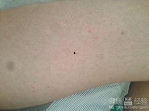 紫癜可以吃梨瓜吗,紫癜患者适宜食用梨瓜的饮食建议